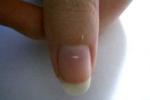 Vita fläckar på naglarna: tecken