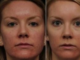 Recensioner från kosmetologer: icke-injektion och nålfri ansiktsmesoterapi